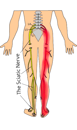 sciatic nerve Pain